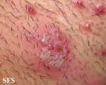 herpetic sycosis