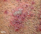 herpetic sycosis
