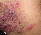 herpetic sycosis