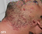 herpetic sycosis