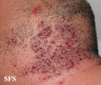 herpetic sycosis