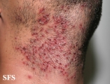 herpetic sycosis