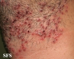 herpetic sycosis