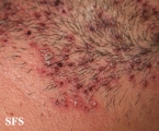 herpetic sycosis