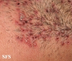 herpetic sycosis