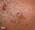 herpetic sycosis