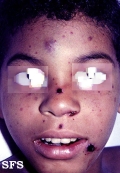 thrombocytopenic purpura idiopatic