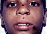 thrombocytopenic purpura idiopatic