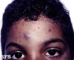 thrombocytopenic purpura idiopatic