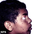 thrombocytopenic purpura idiopatic