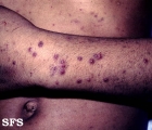 thrombocytopenic purpura idiopatic