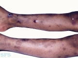 thrombocytopenic purpura idiopatic
