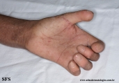 systemic_sclerosis