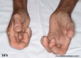 systemic_sclerosis