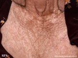 systemic_sclerosis