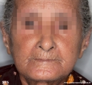 systemic_sclerosis