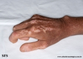 systemic_sclerosis