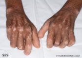 systemic_sclerosis