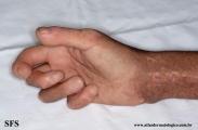 systemic_sclerosis