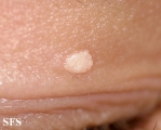 calcinosis cutis
