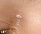 calcinosis cutis