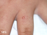 calcinosis cutis