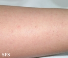 calcinosis cutis