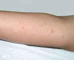 calcinosis cutis