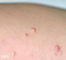 calcinosis cutis