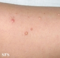 calcinosis cutis