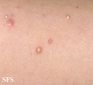 calcinosis cutis