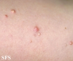 calcinosis cutis