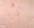 calcinosis cutis