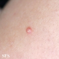 calcinosis cutis