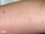 calcinosis cutis