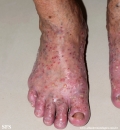 pustulosis palmaris et plantaris