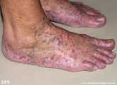 pustulosis palmaris et plantaris