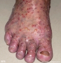 pustulosis palmaris et plantaris