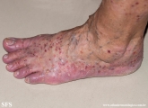 pustulosis palmaris et plantaris