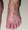 pustulosis palmaris et plantaris