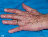 pustulosis palmaris et plantaris