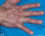 pustulosis palmaris et plantaris