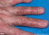pustulosis palmaris et plantaris