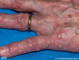 pustulosis palmaris et plantaris