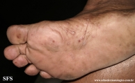 pustulosis palmaris et plantaris