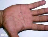 pustulosis palmaris et plantaris