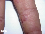pustulosis palmaris et plantaris