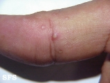 pustulosis palmaris et plantaris