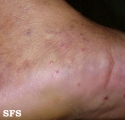 pustulosis palmaris et plantaris