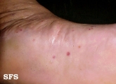 pustulosis palmaris et plantaris